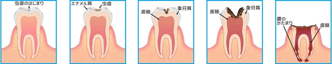 虫歯の進行イメージ