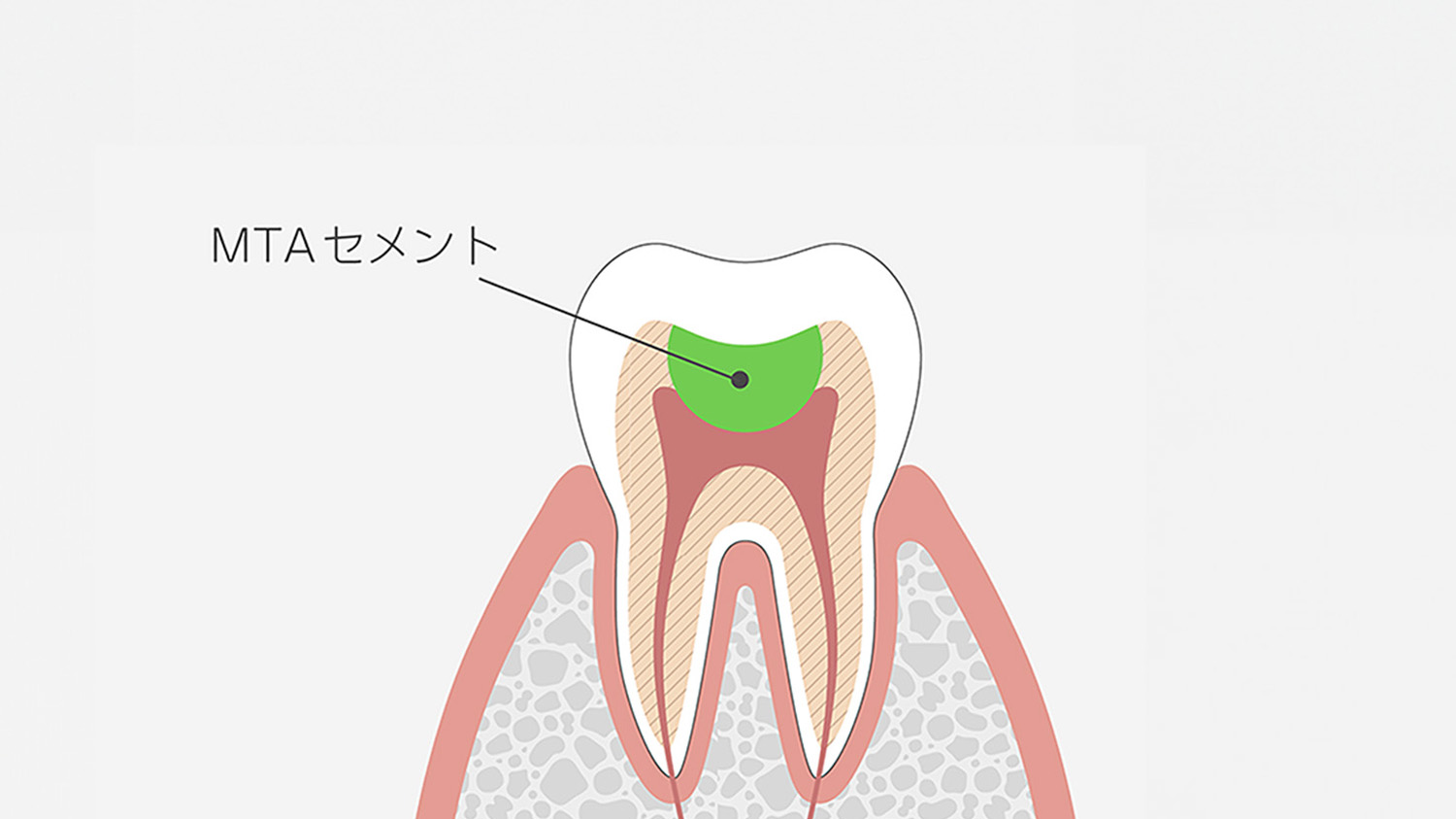 MTAセメントによる神経保護処置