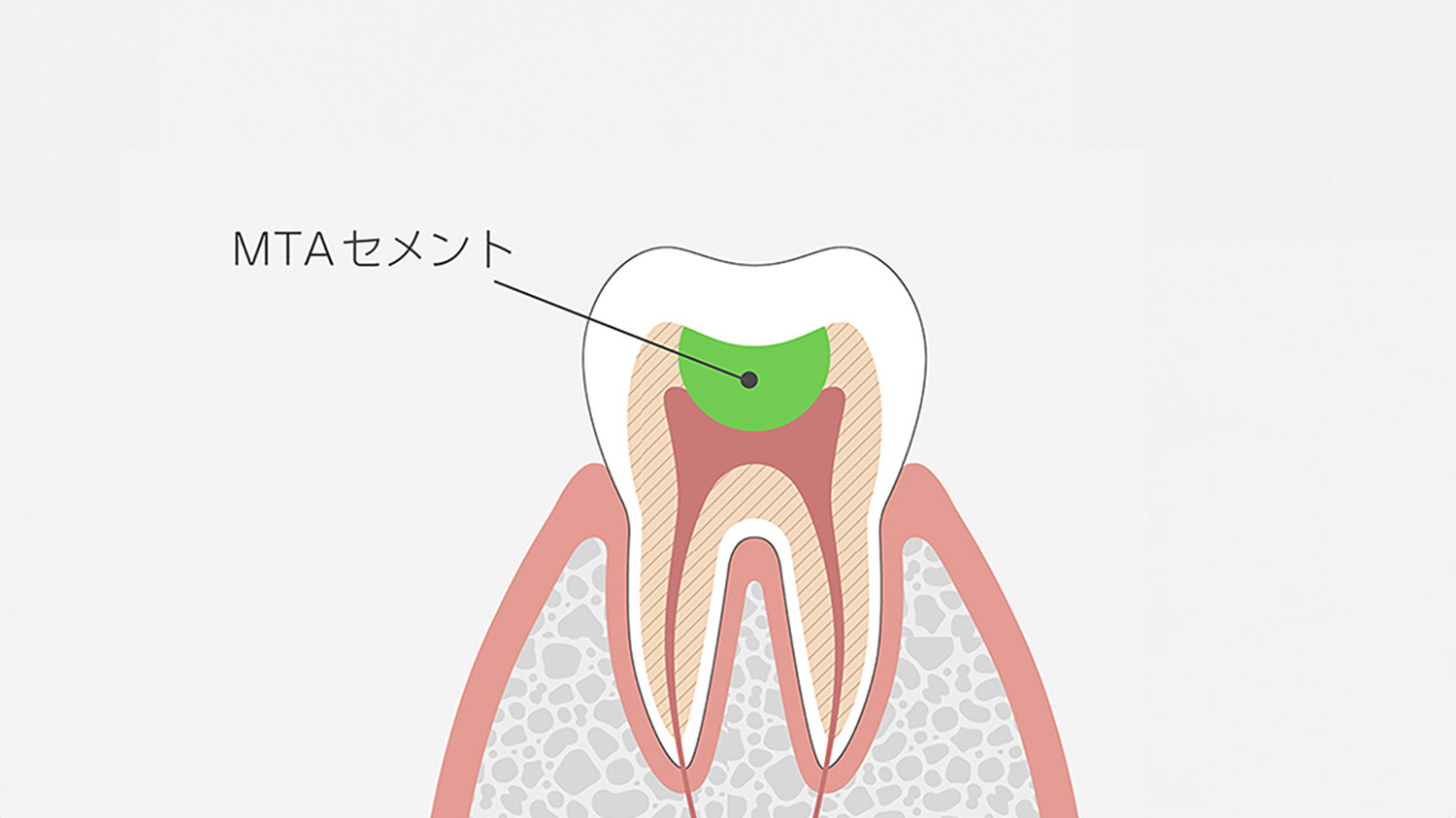 MTAセメント